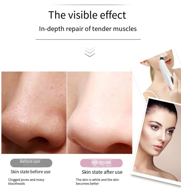 Diamond Pore Cleansing Vacuum